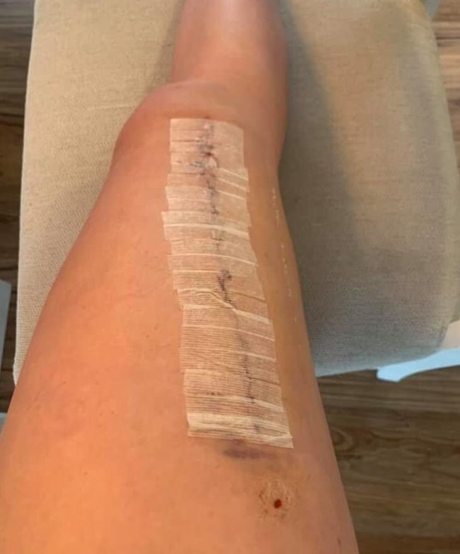 Alexis Carrico surgery 4.jpg